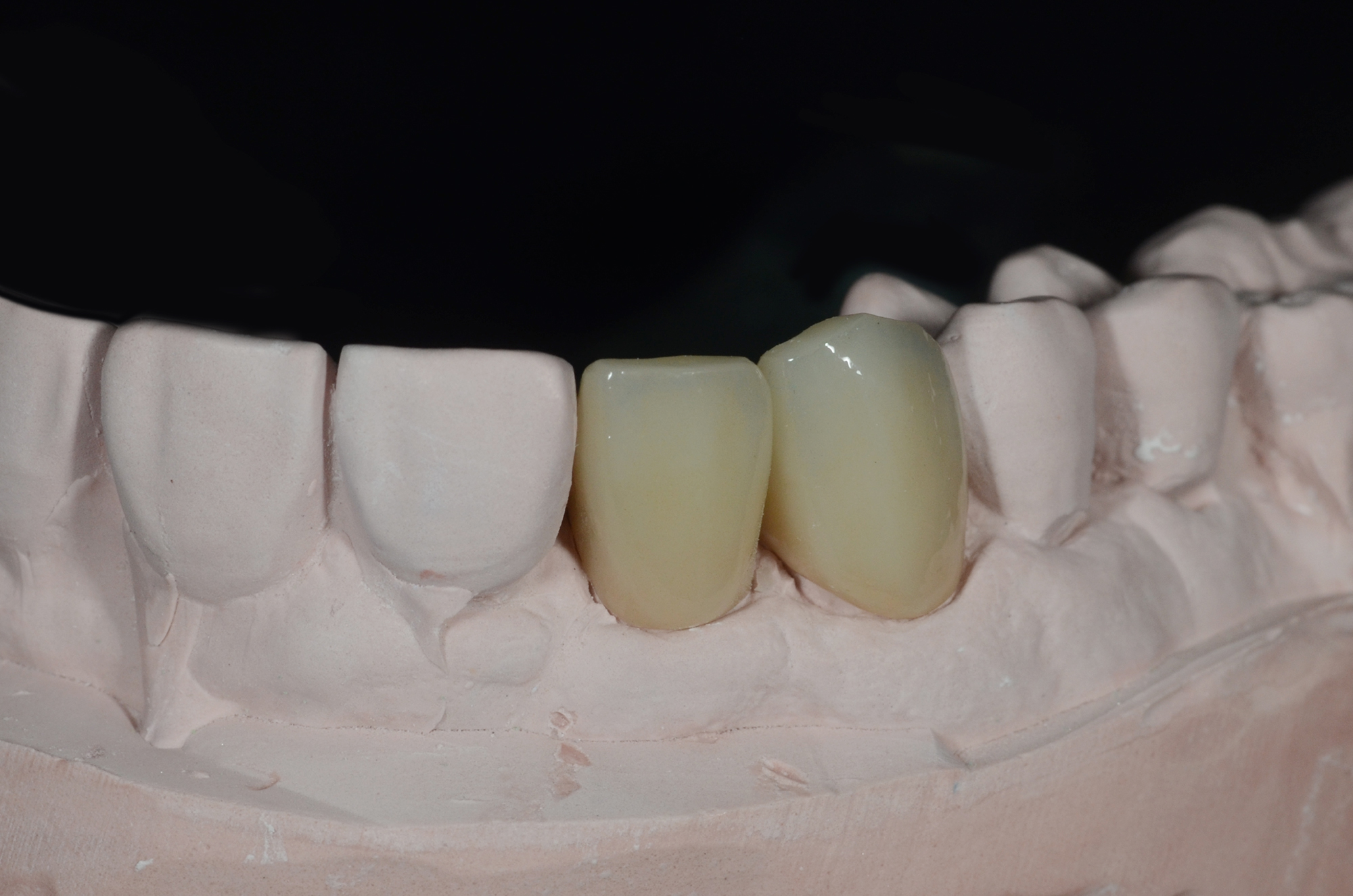 Zirconia Post and Core